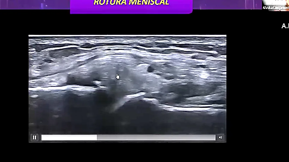 Ultrassonografia de ruptura meniscal, quadro da aula de patologias do joelho