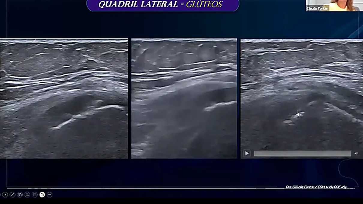 Tr&ecirc;s planos do quadril lateral mostrando os tend&otilde;es gl&uacute;teos