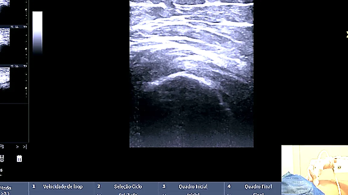 Tela do aparelho de ultrassom durante o tutorial de quadril