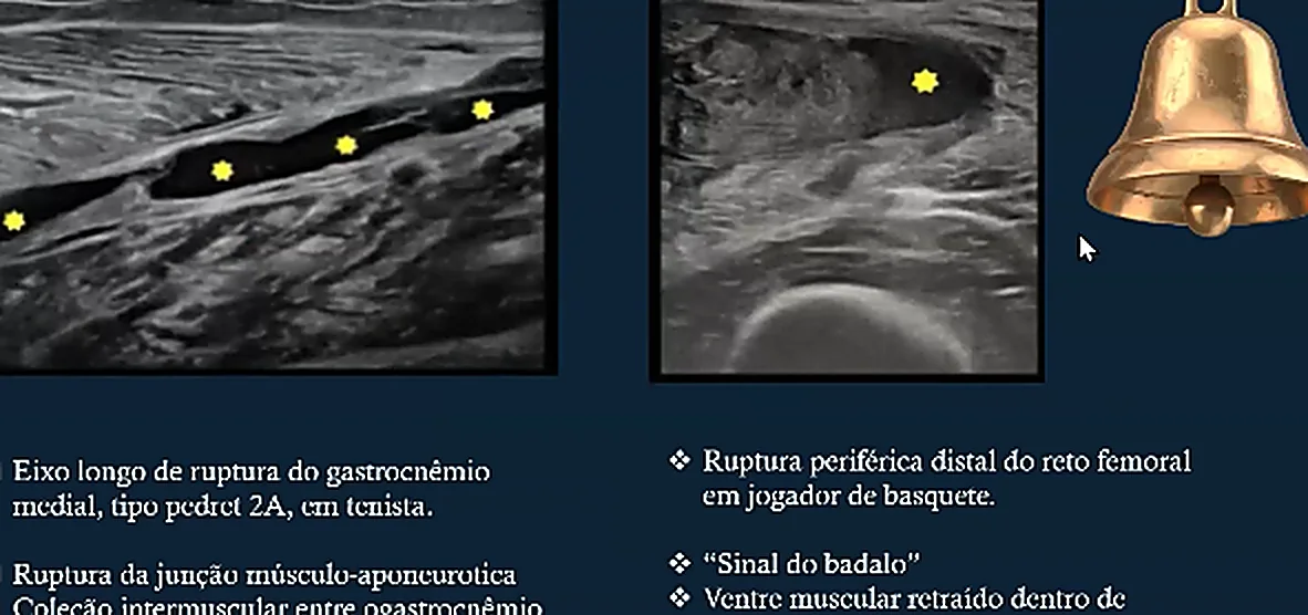 Ultrassonografia de ruptura muscular extensa com o ventre m&oacute;vel dentro do hematoma