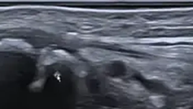 Quadro do caso comentado de carpal boss