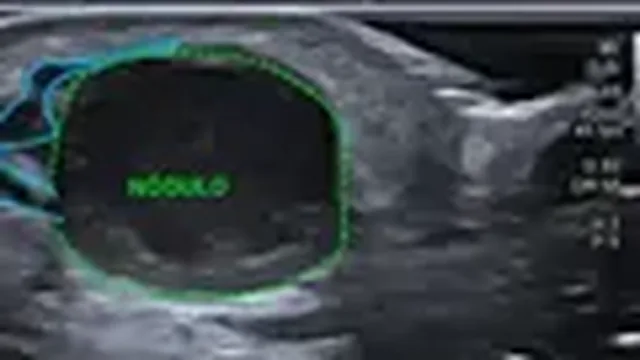 Quadro do caso comentado de trombose que se apresenta como tumor no dedo