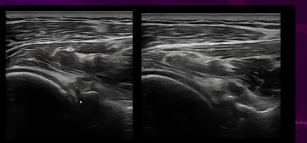 Ultrassom do ombro posterior com les&atilde;o labral e cisto ocupando a incisura espinoglenoidal