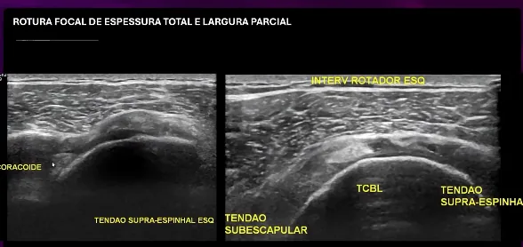 Compara&ccedil;&atilde;o de ultrassom dos tend&otilde;es supraespinhal e subescapular com marca&ccedil;&otilde;es