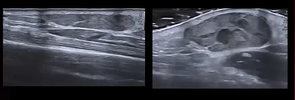Dois cortes de ultrassom de uma massa de partes moles antes e durante a compress&atilde;o