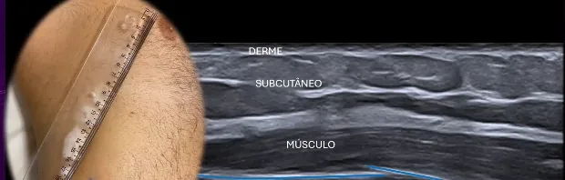 R&eacute;gua marcando na pele o ponto onde o paciente sente dor, ao lado do ultrassom com as camadas identificadas