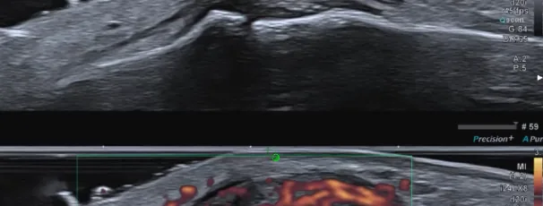 O mesmo ligamento do dedo em dois modos: acima em escala de cinza, abaixo com Doppler mostrando a vasculariza&ccedil;&atilde;o